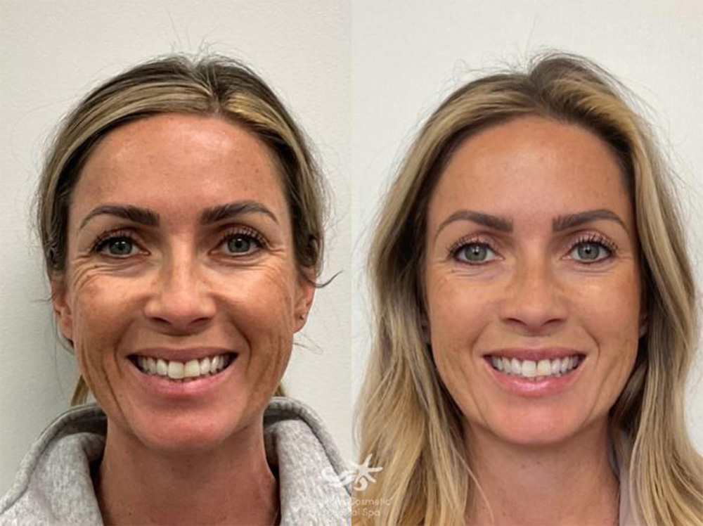 Liquid Face Lift with fillers and botox