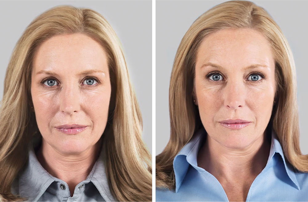 Liquid Face Lift results