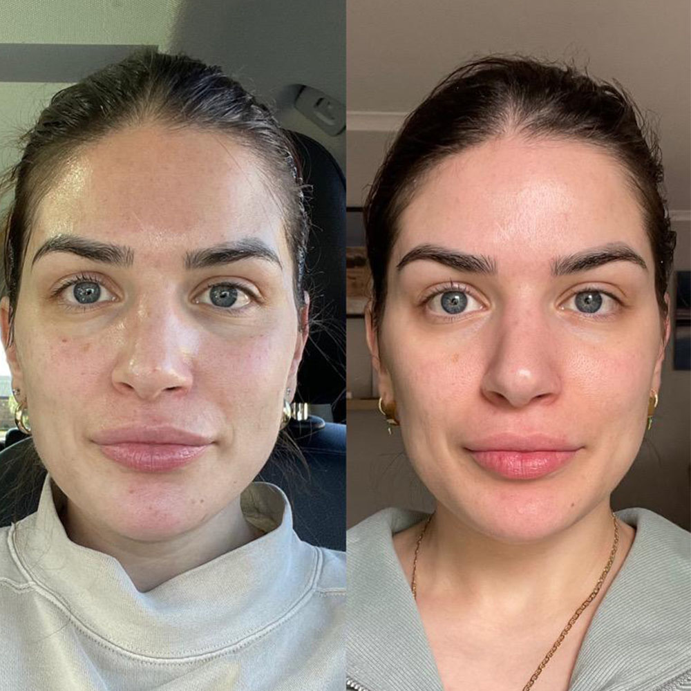 Liquid Face Lift before and after