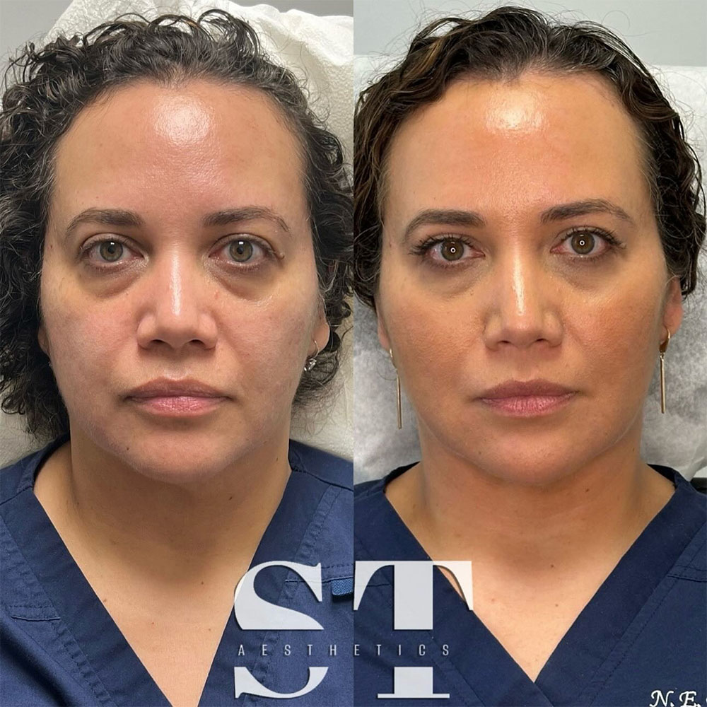 Liquid Face Lift transformation