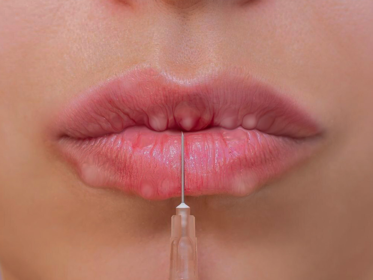 Lip Filler Lumps Months Later: Causes, Risks, and Treatment Options