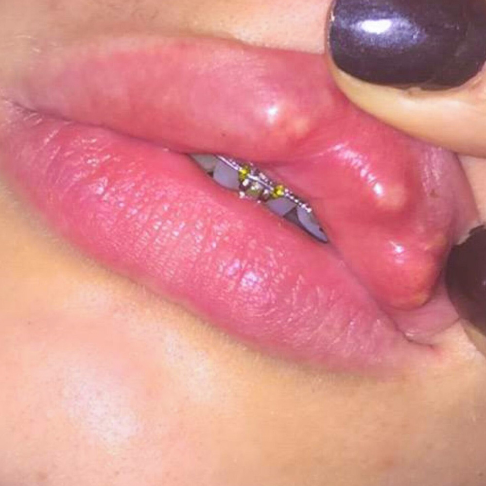 lip filler lumps months later