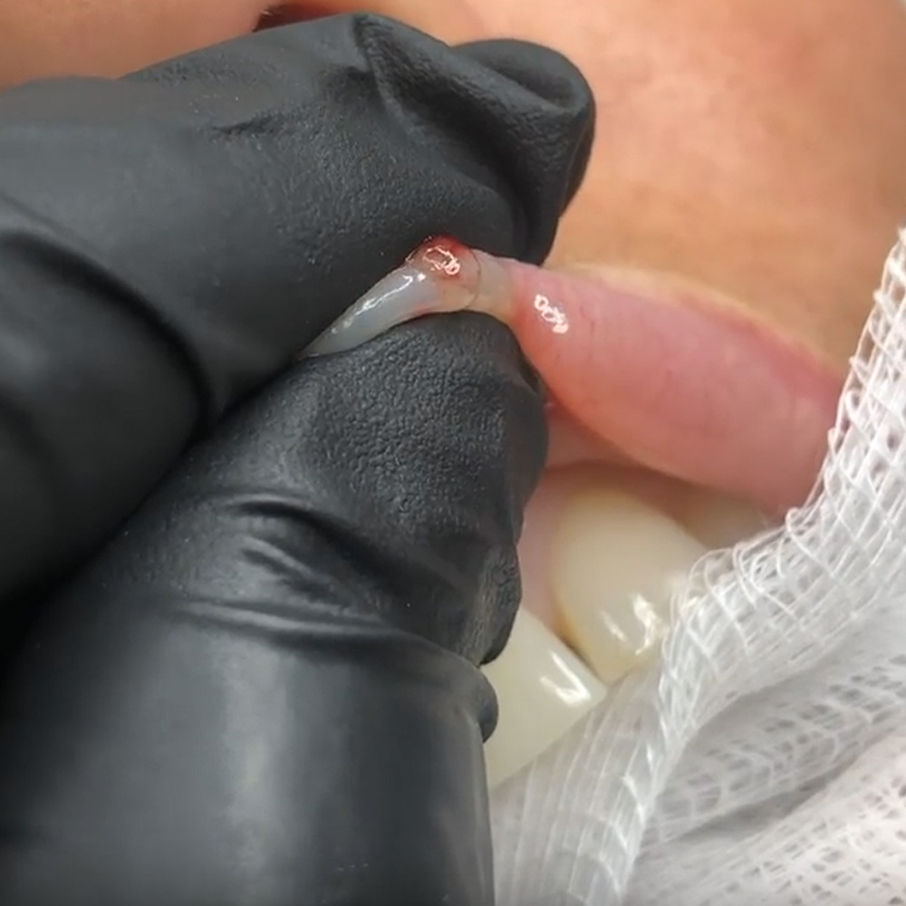 lip filler lumps months later