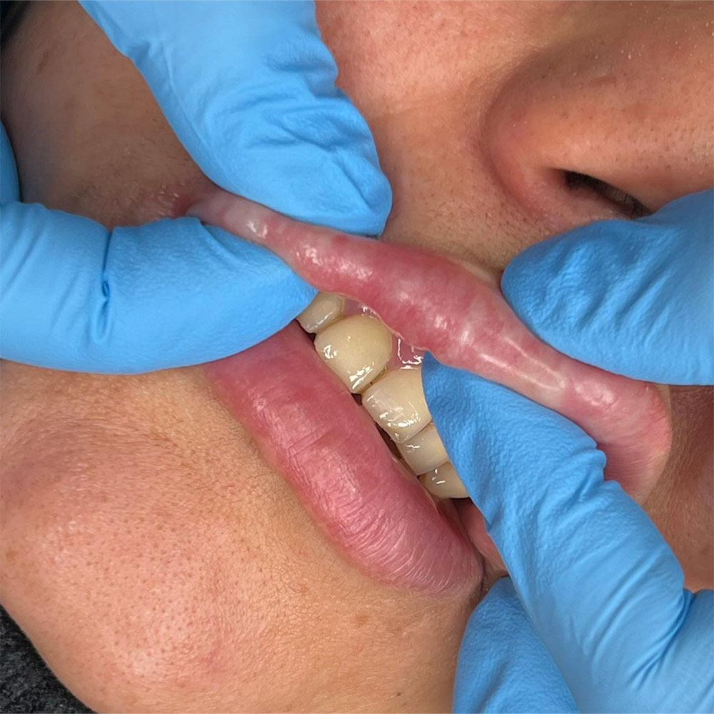 lip filler lumps months later