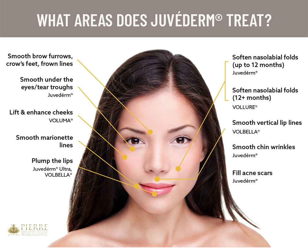 juvederm side effects