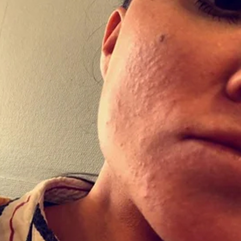juvederm side effects