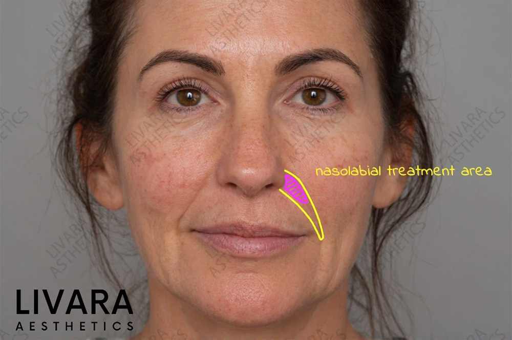 juvederm nasolabial folds