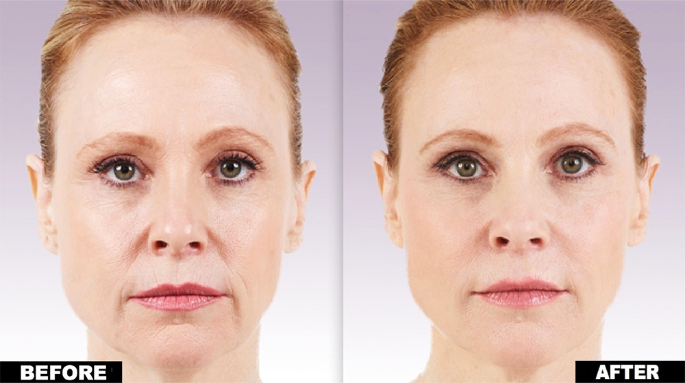 Juvéderm for marionette lines
