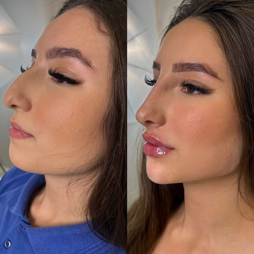 Restylane vs Juvederm