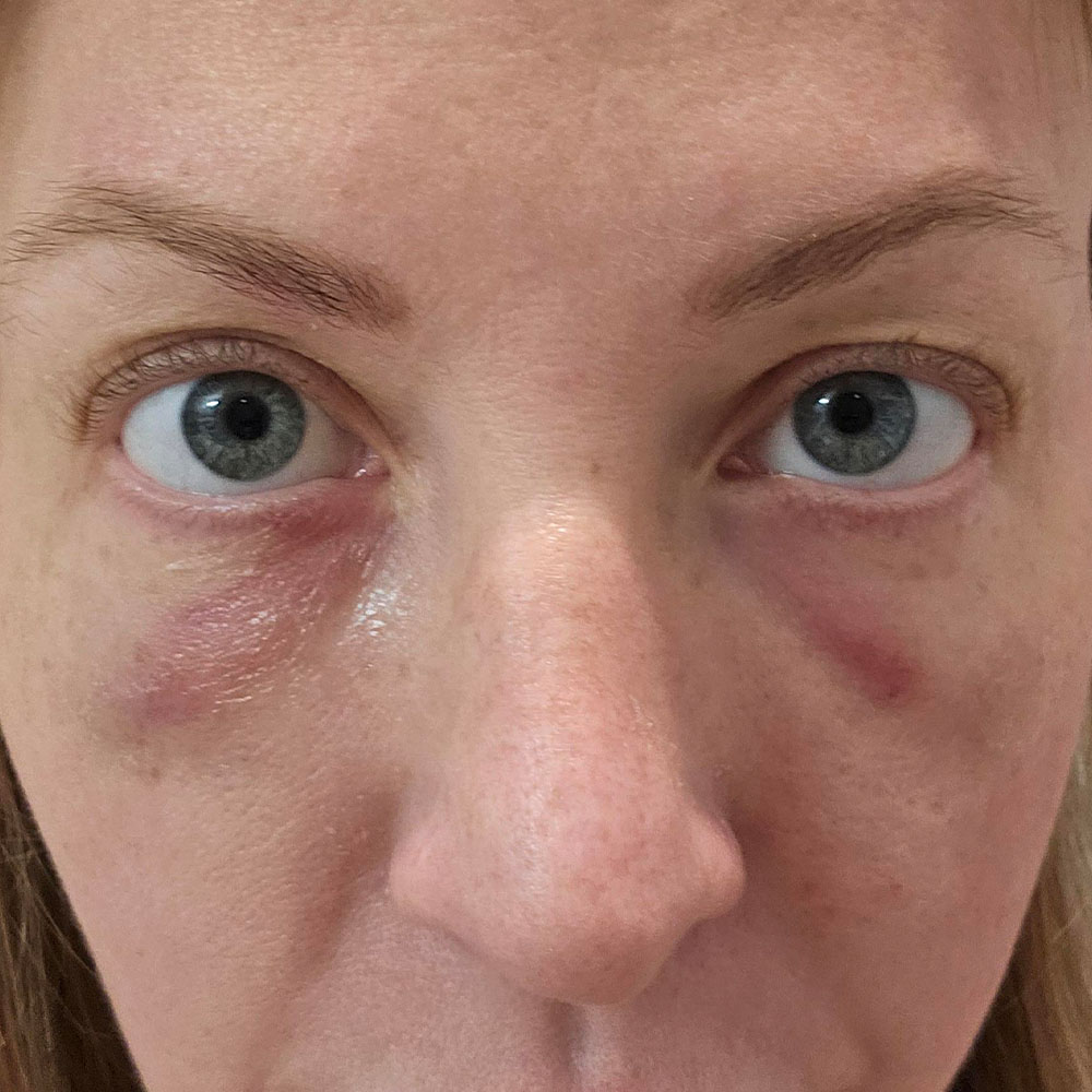 under-eye fillers gone wrong