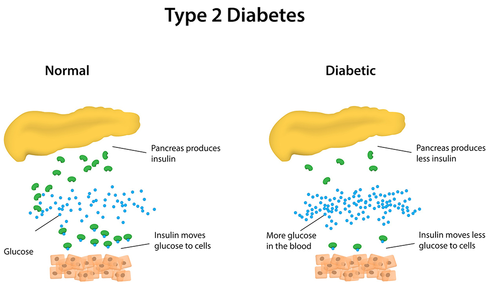 type 2 diabetes