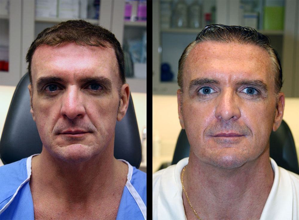 anti aging stem cell therapy results in men