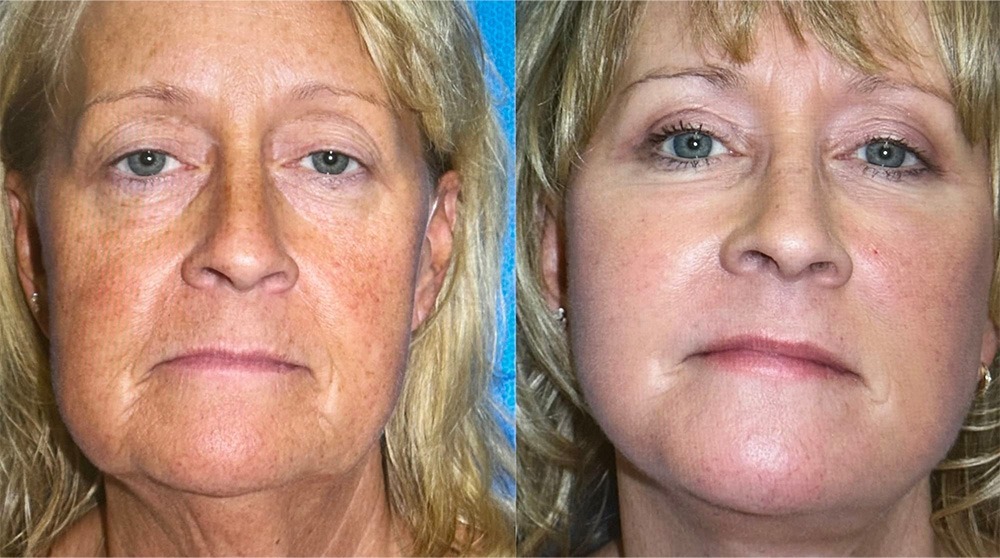 anti aging stem cell therapy results in women