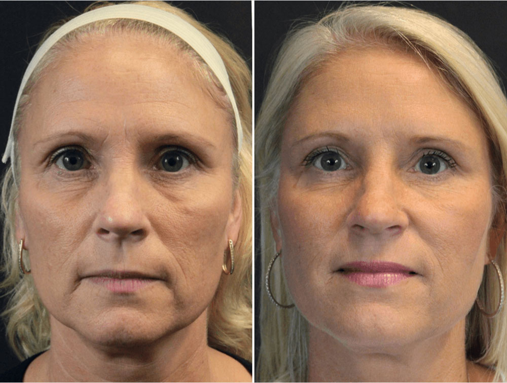 aesthetic treatment for tired face