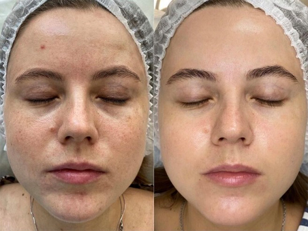 PRX‑T33 biorevitalization Unicorn facial before and after