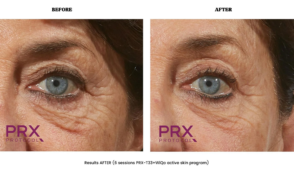 PRX‑T33 Unicorn facial