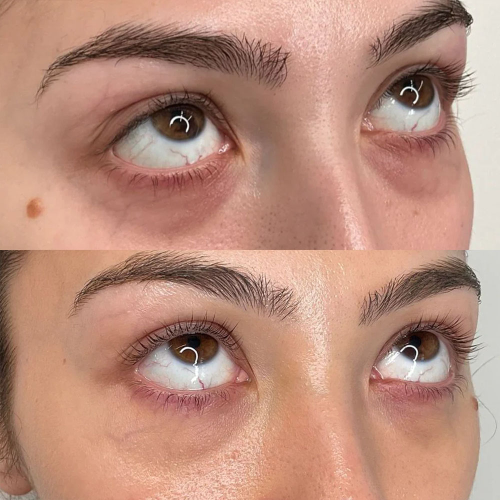 prf ez gel under eye results