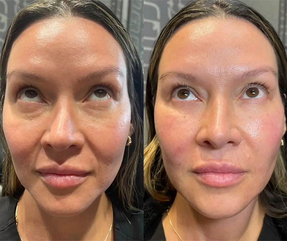 prf ez gel under eye before and after results
