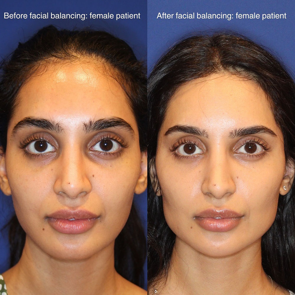 facial balancing before and after on female patient