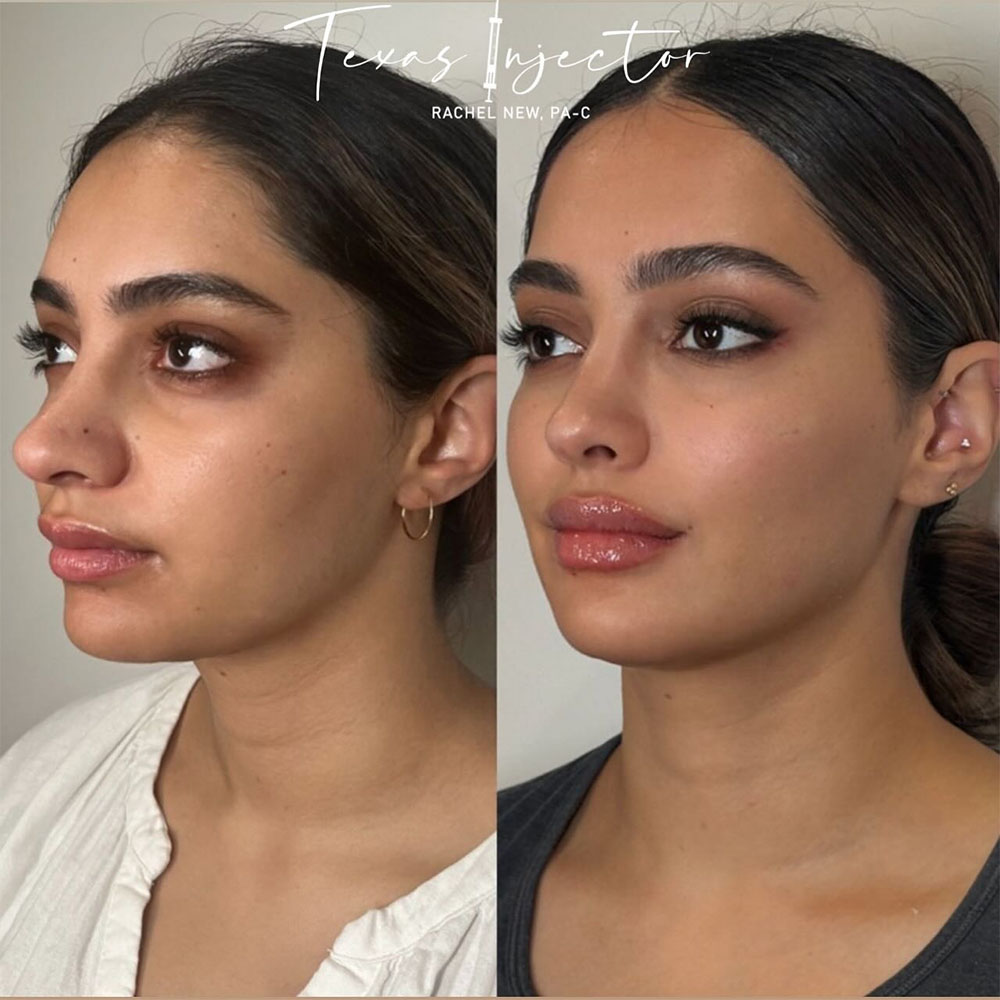 facial balancing before and after results