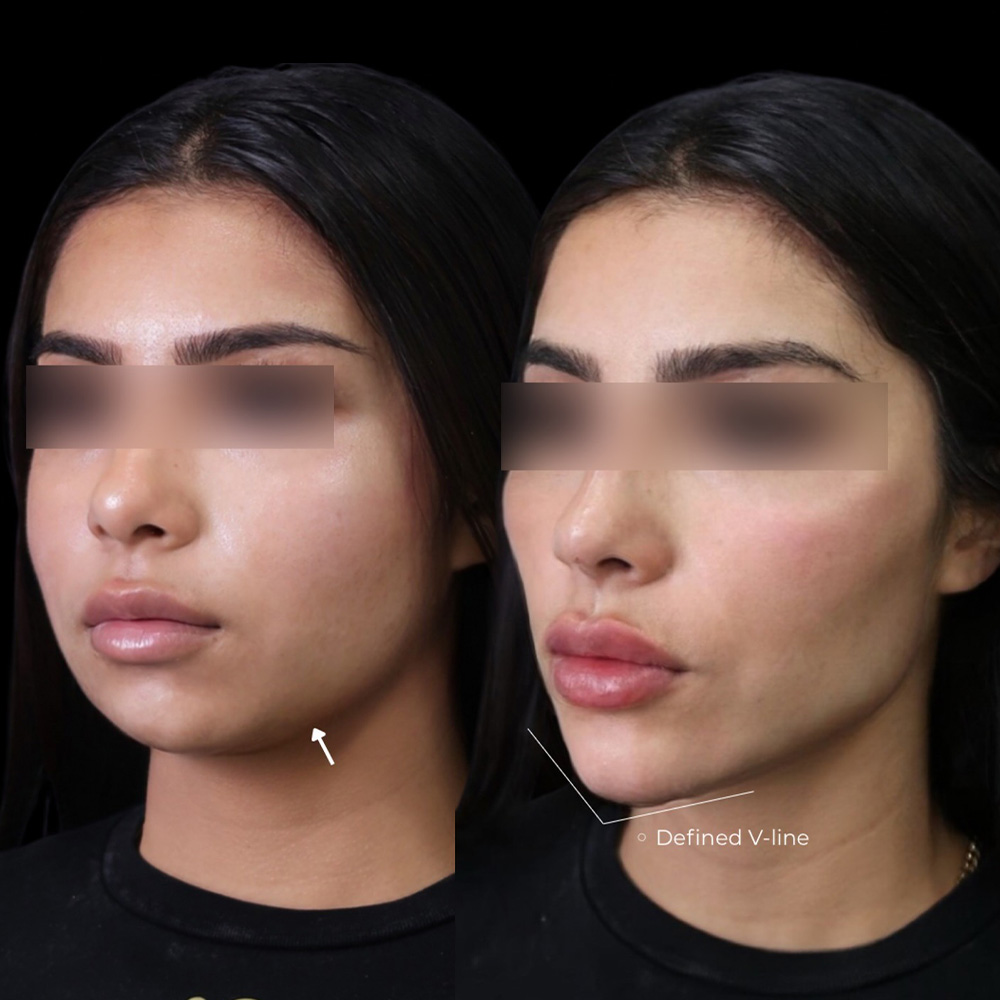 facial balancing before and after transformations