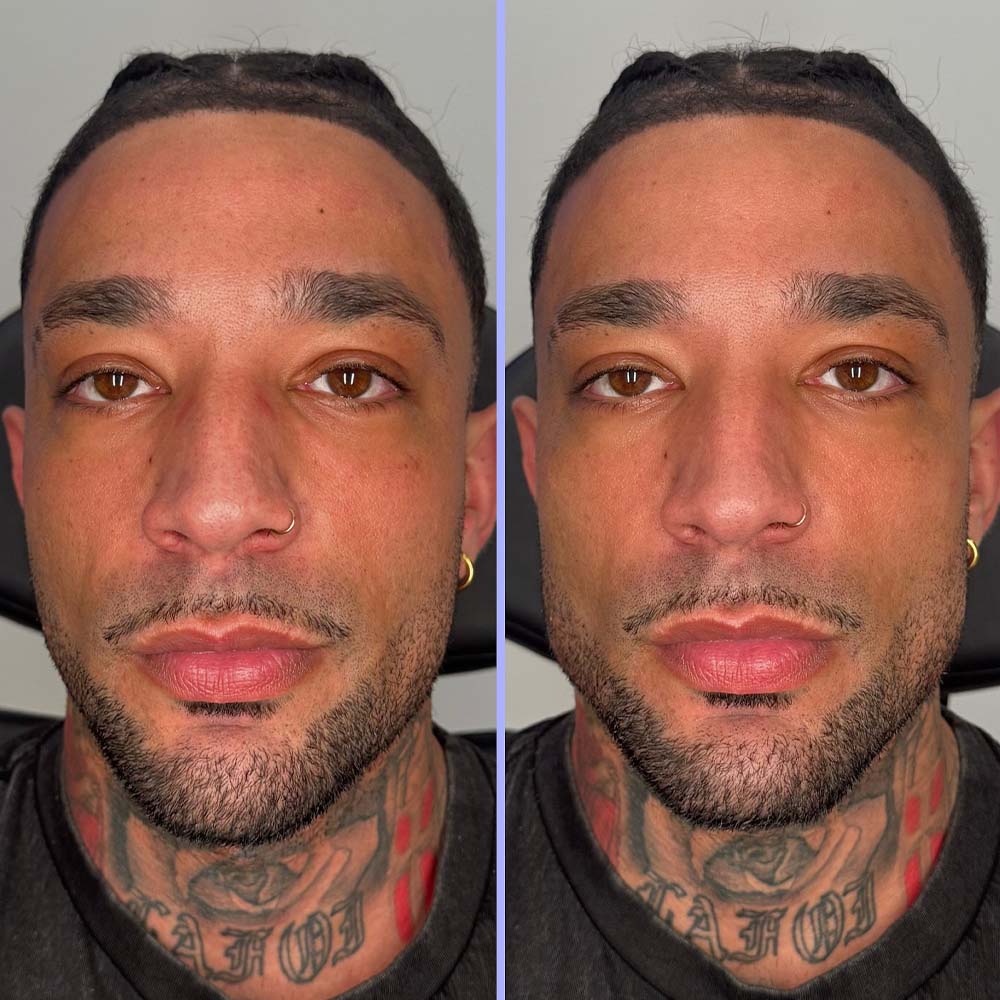 facial balancing before and after male patient