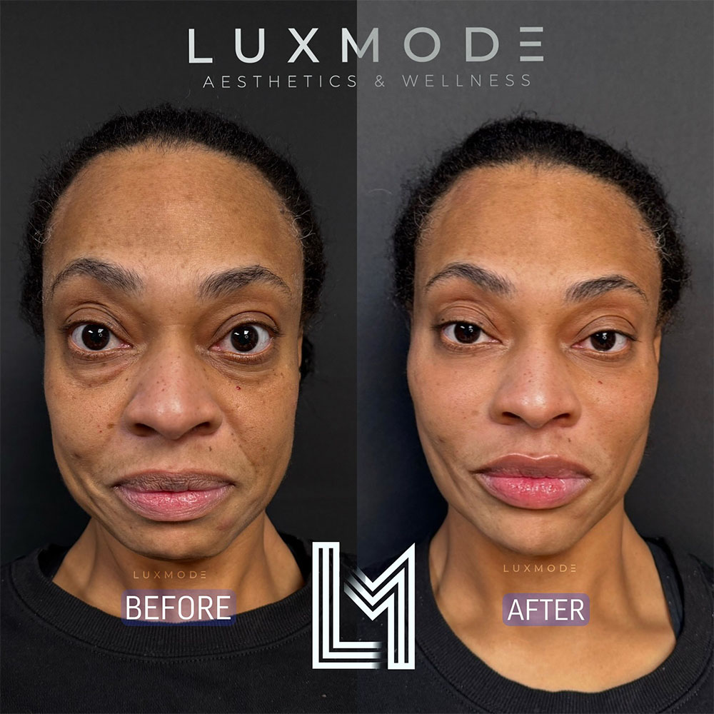 facial balancing before and after on female face