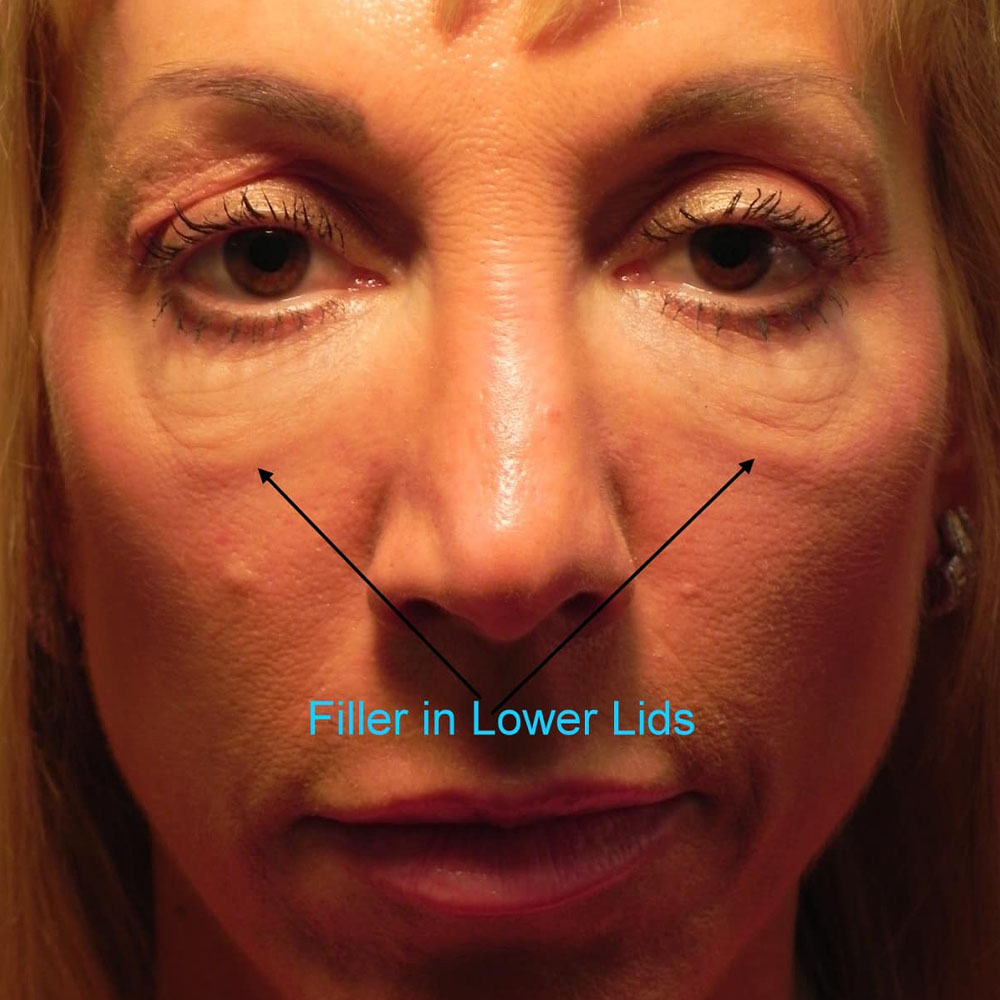 Under Eye Filler Migration
