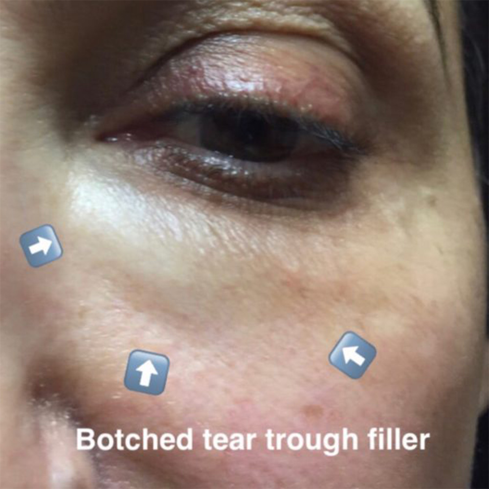 Under Eye Filler Migration