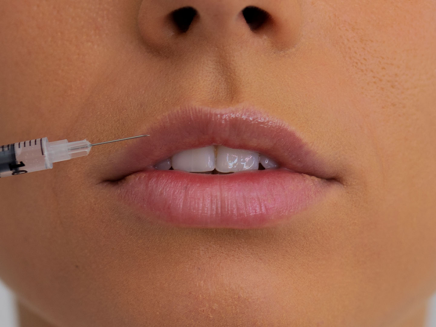 Swedish Lip Filler Technique: Subtle Volume with Scandinavian Precision