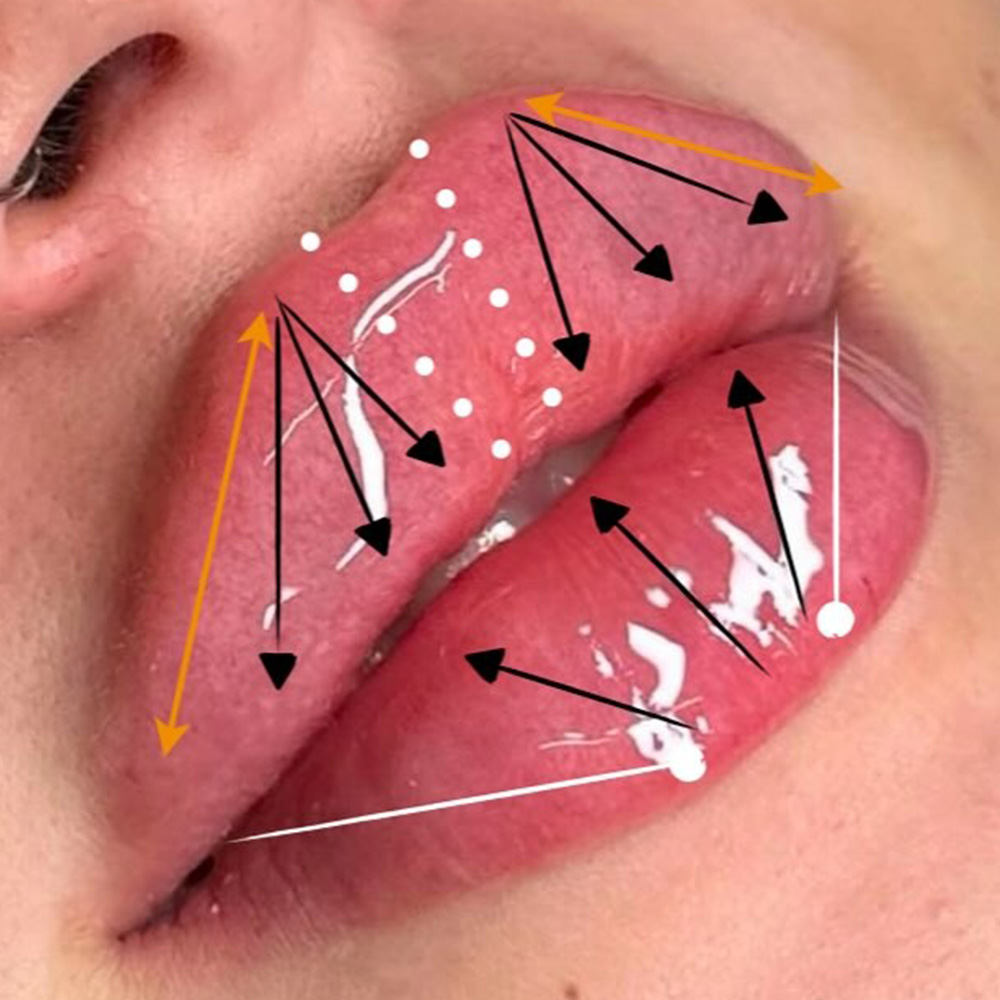 lip filler injection points