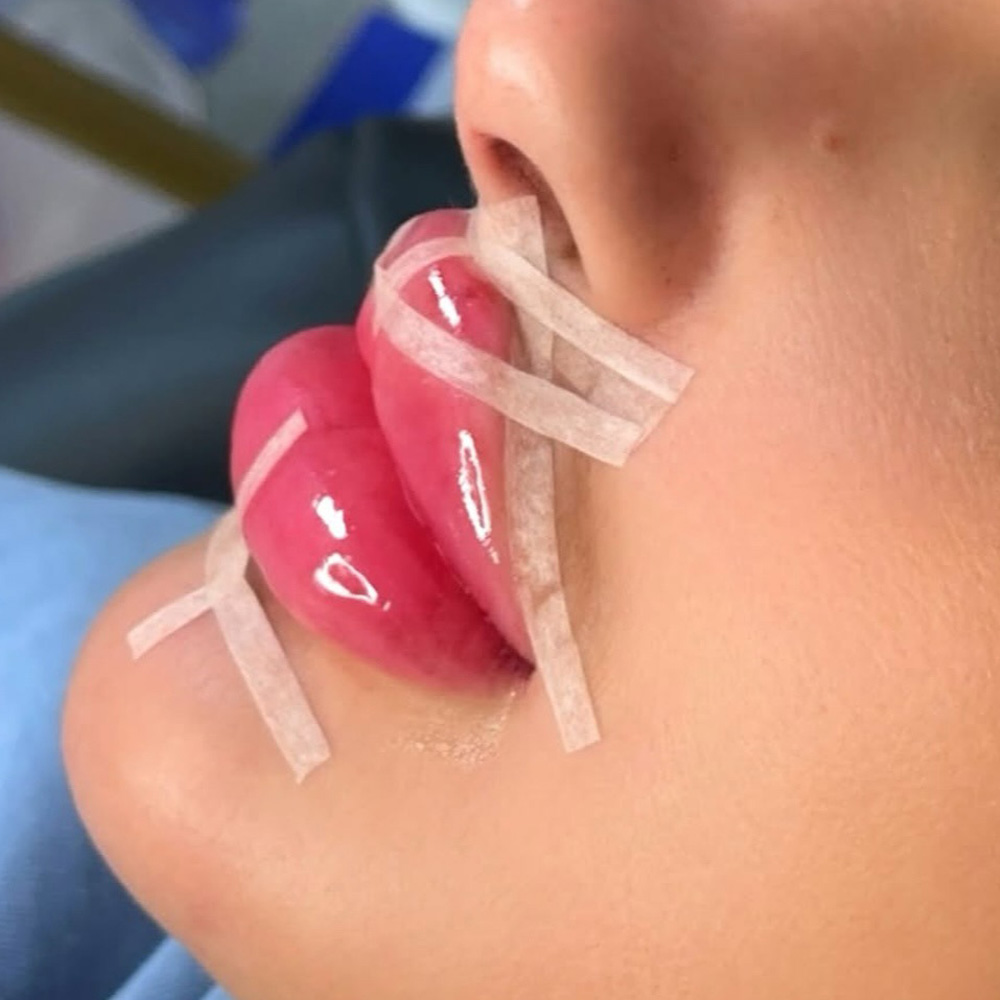 doll lips filler