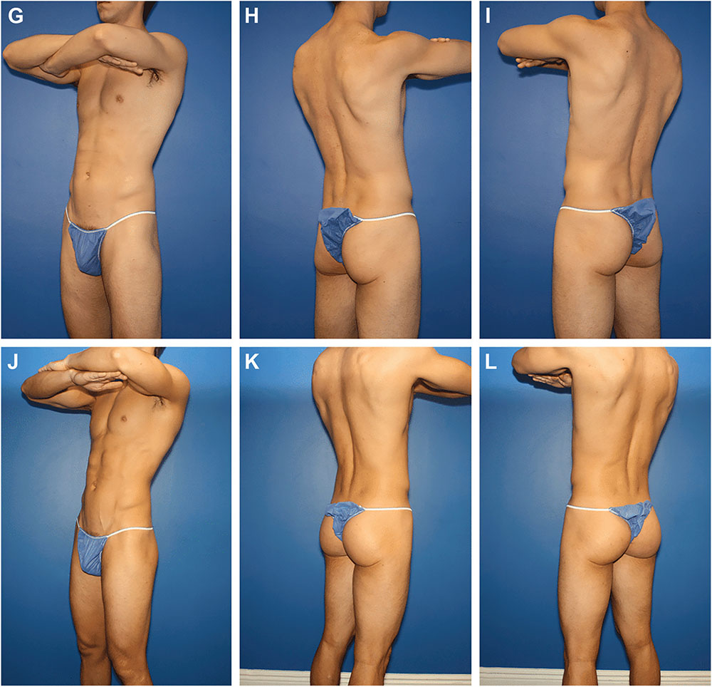 butt augmentation in men