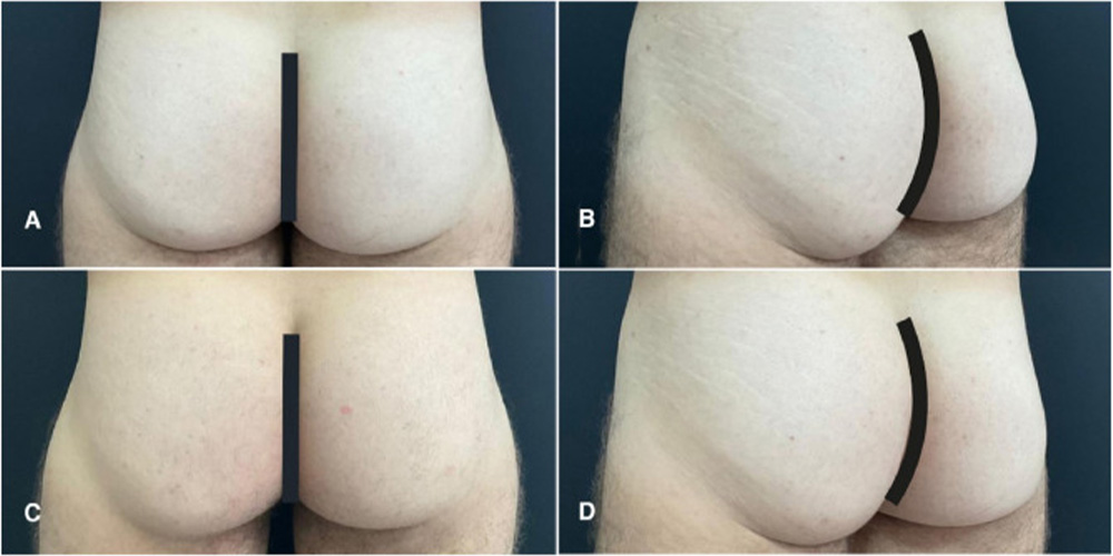 butt augmentation in men with poly-L-lactic acid for treating gluteal skin laxity