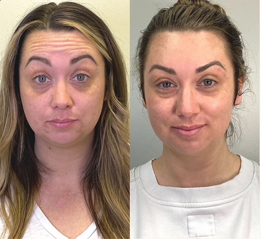 spock brow after botox