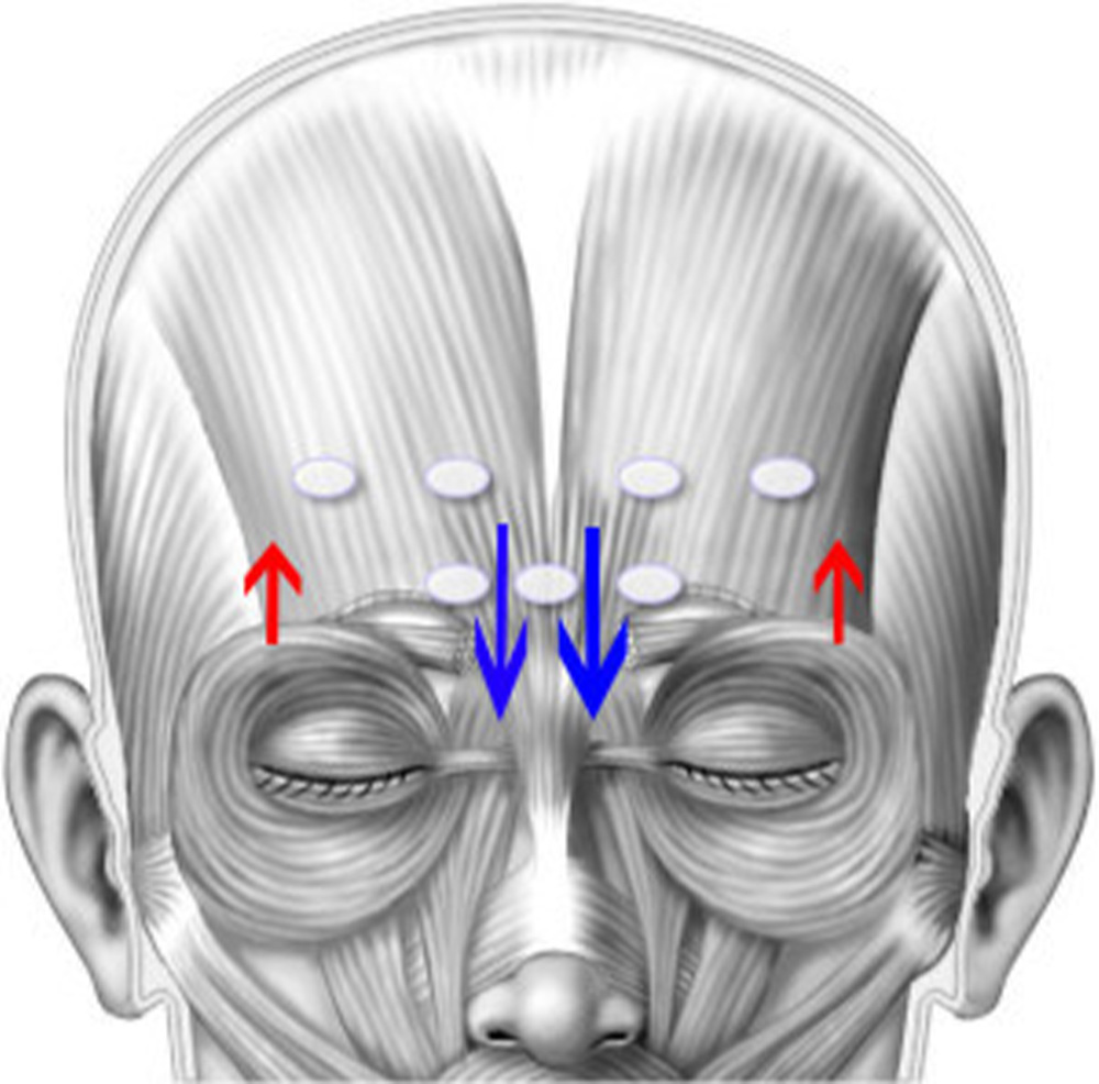 botox spock brow