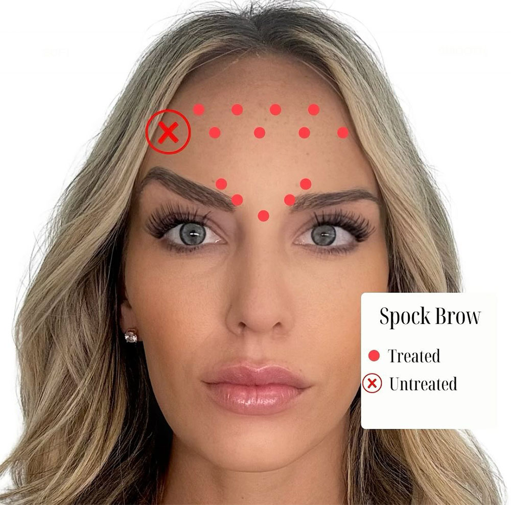 botox spock brow treated vs untreated