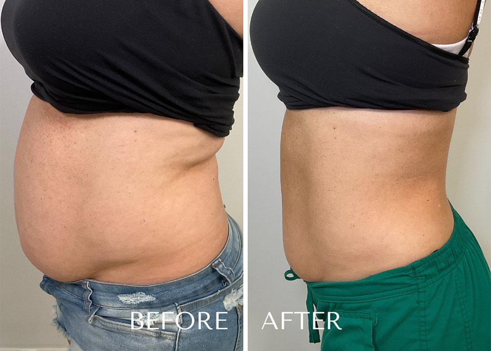 lipotropic injections before and after on female patients