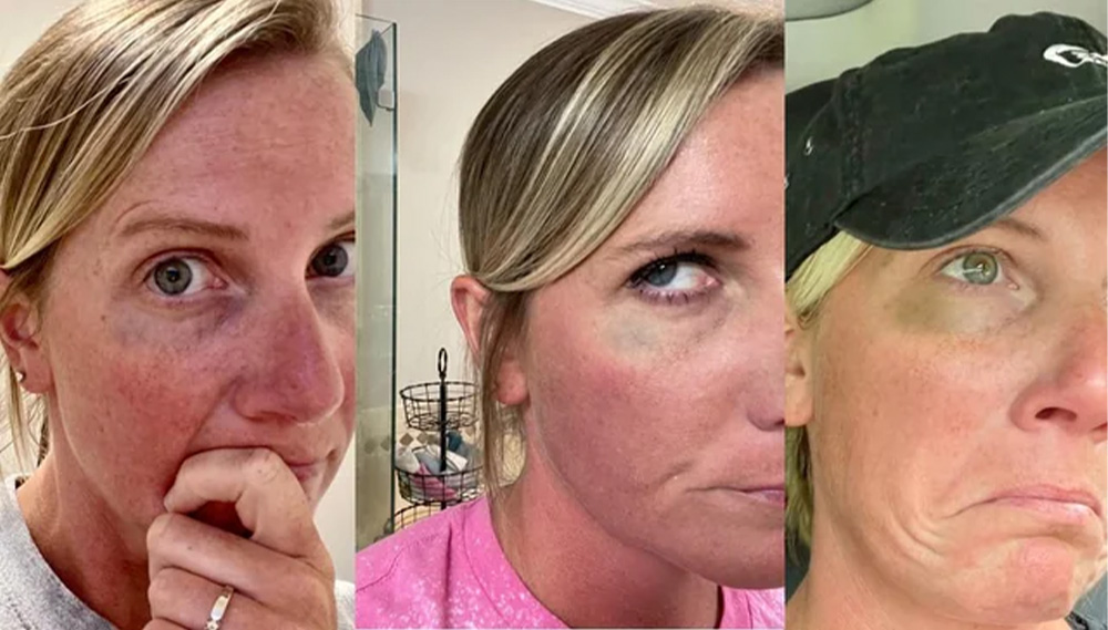 botox bruising