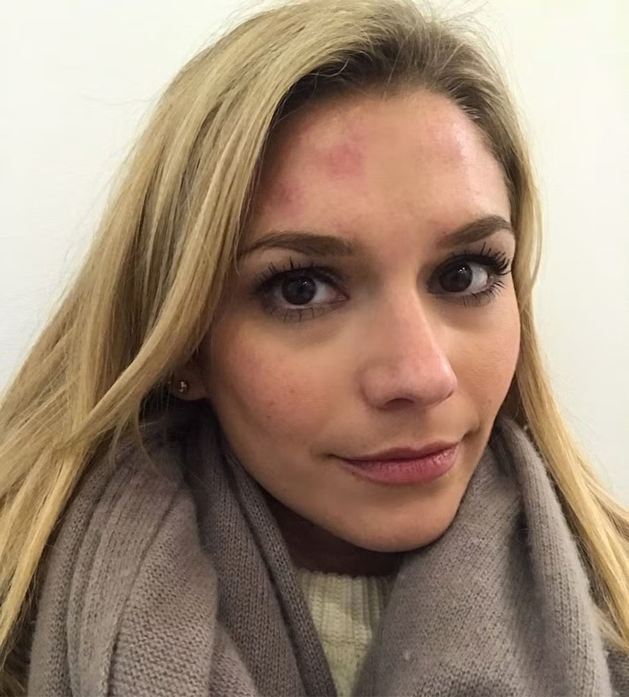 botox bruising