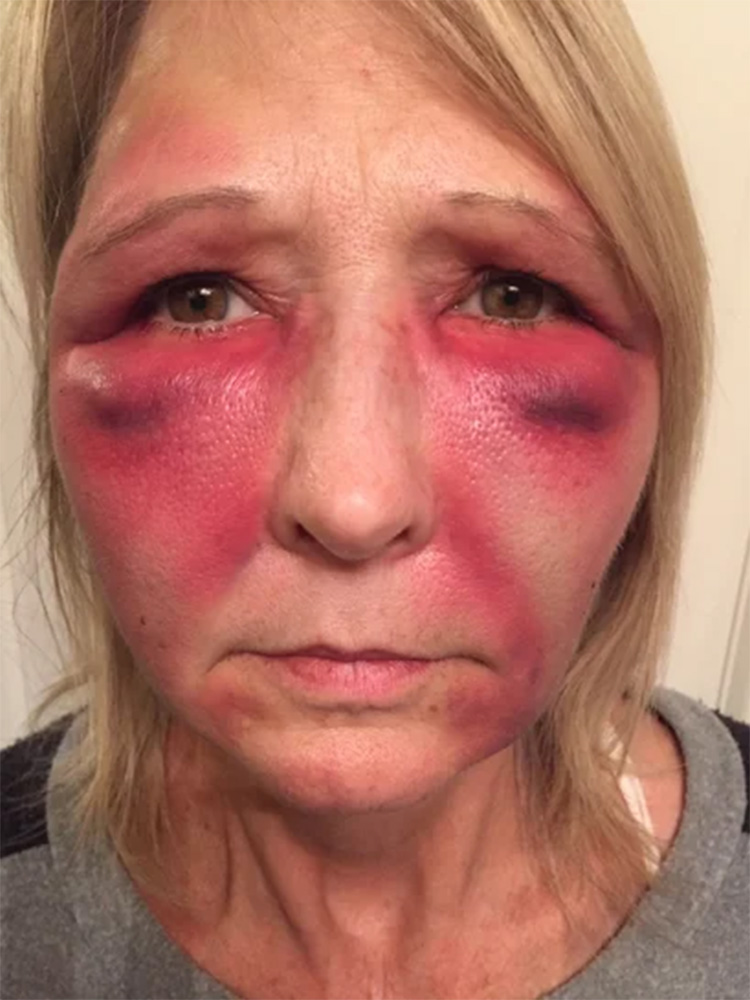 severe botox bruising