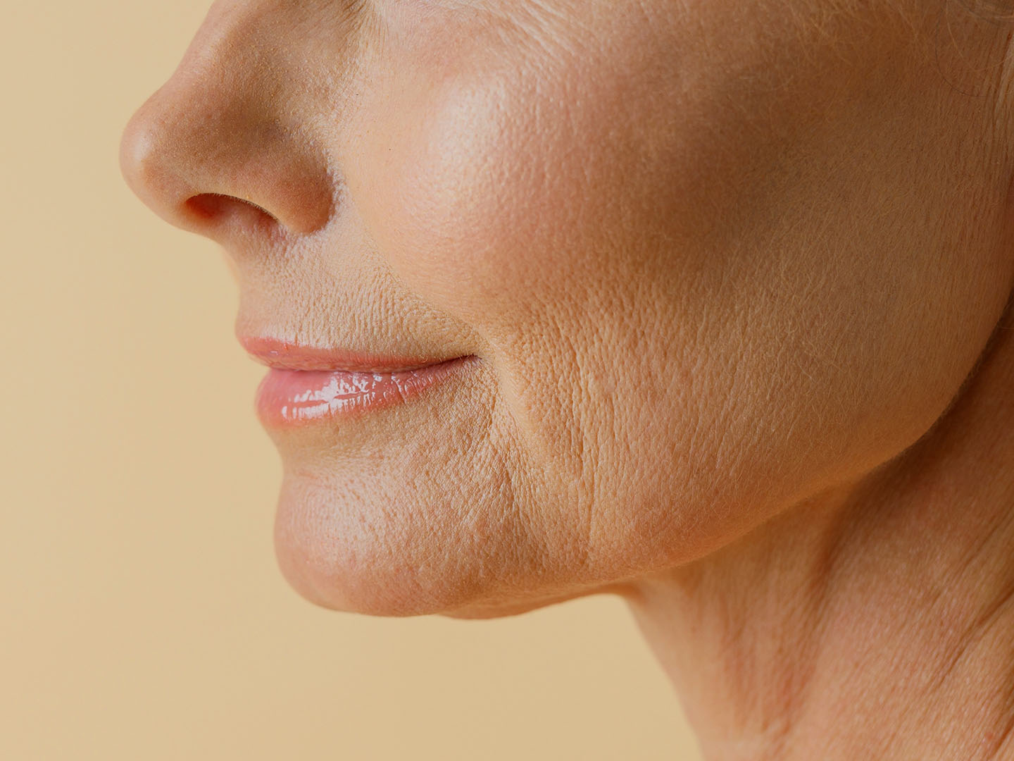 Prejowl Sulcus: Causes and Treatment Strategies with Dermal Fillers