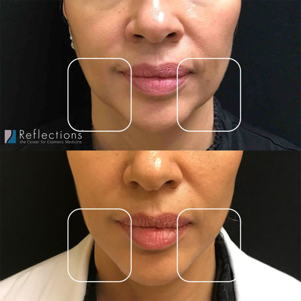 prejowl sulcus before and after treatment