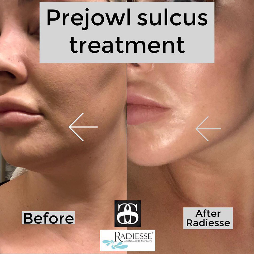 prejowl sulcus before and after treatment with radiesse