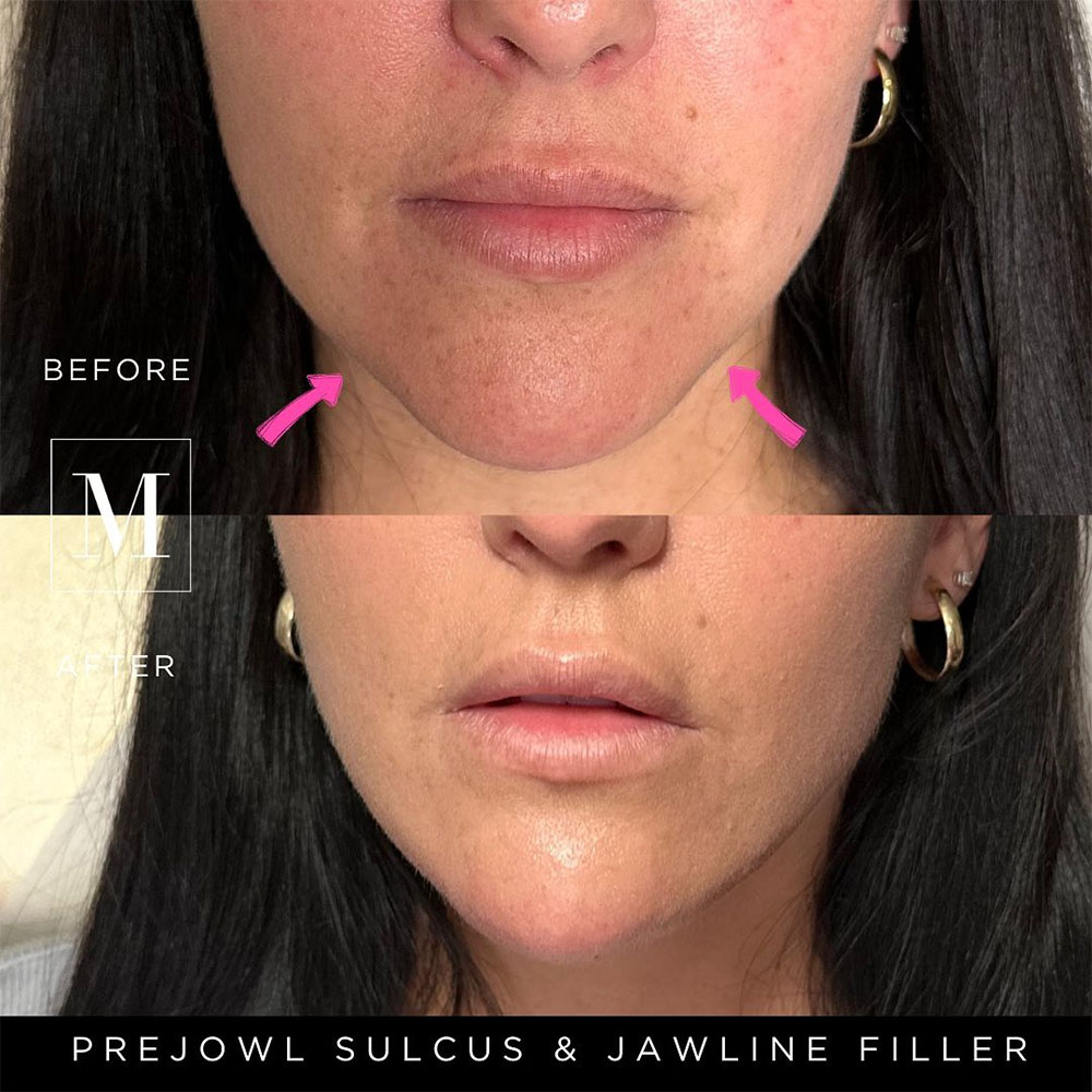 prejowl sulcus treatment with fillers results on woman face