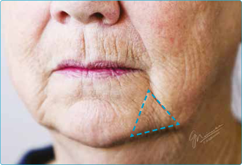 how does prejowl sulcus form