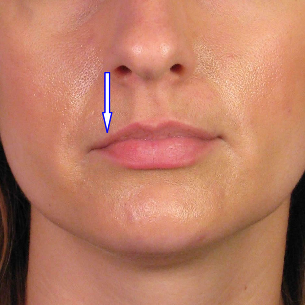 what is lip ptosis