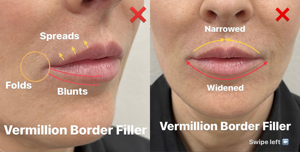 vermilion border filler