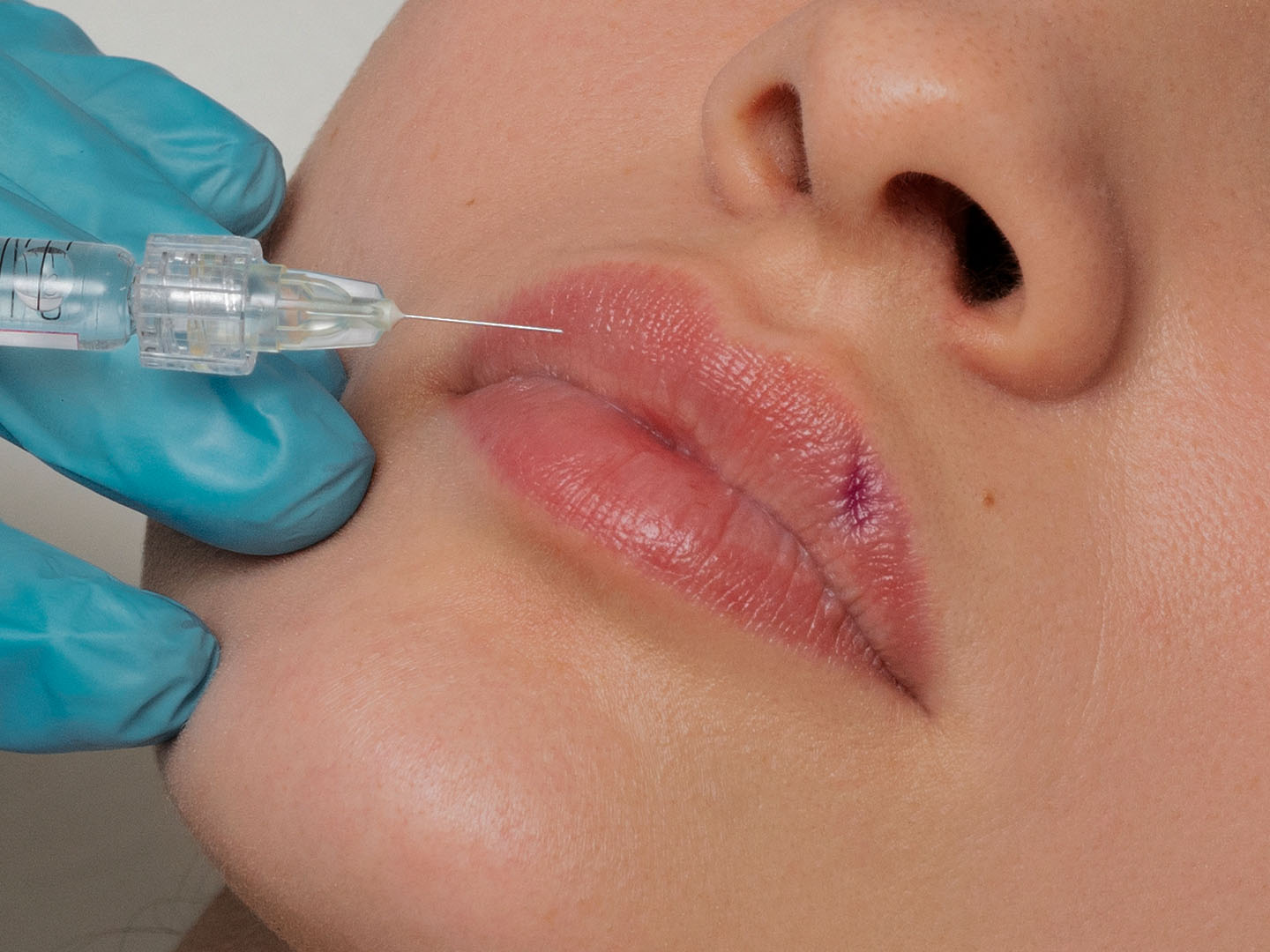 Lip Filler and Scars: Correction, Best Techniques, and Prevention