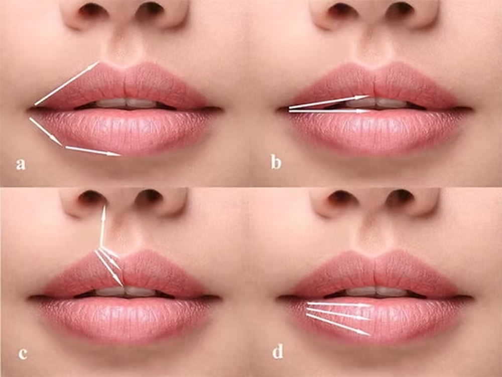 lip filler techniques